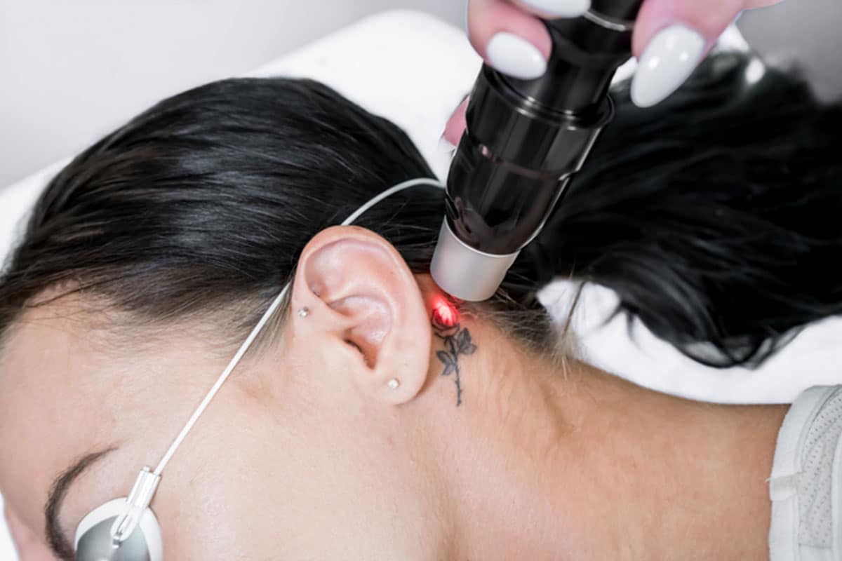 Patient getting tattoo removed behind ear