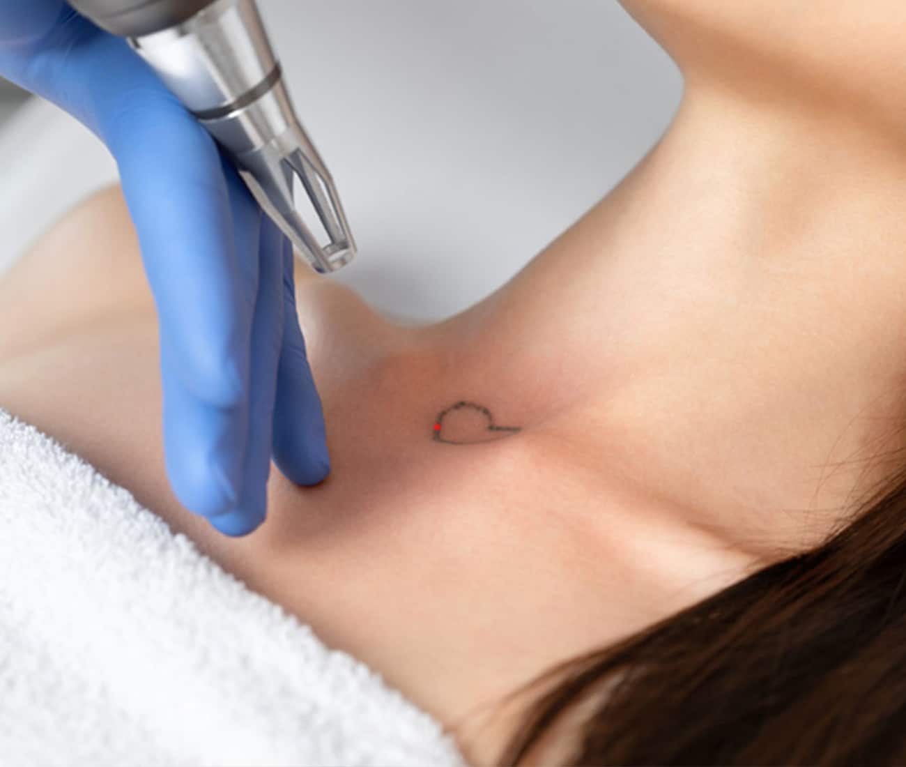 Laser Tattoo Removal - Las Vegas, Henderson, St George | Vivida Dermatology