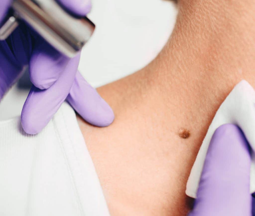 Mole Removal Services Beaufort Sc Pinnacle Dermatology