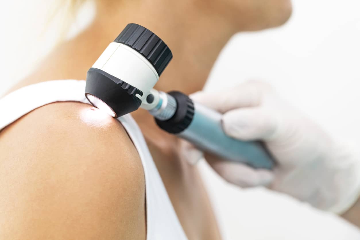 Doctor Examining Melanoma, Using Dermatoscope, As Part Of A Summer Skin Check
