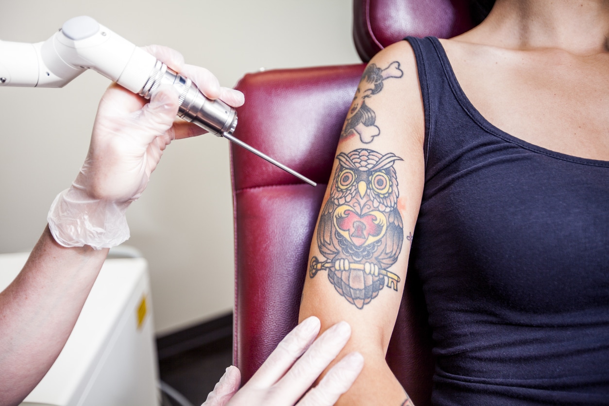 Laser Tattoo Removal  Skinduced Aesthetics Clinic