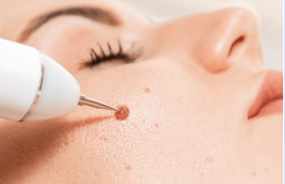 A Woman Receives A Professional Mole Removal Treatment On Her Face