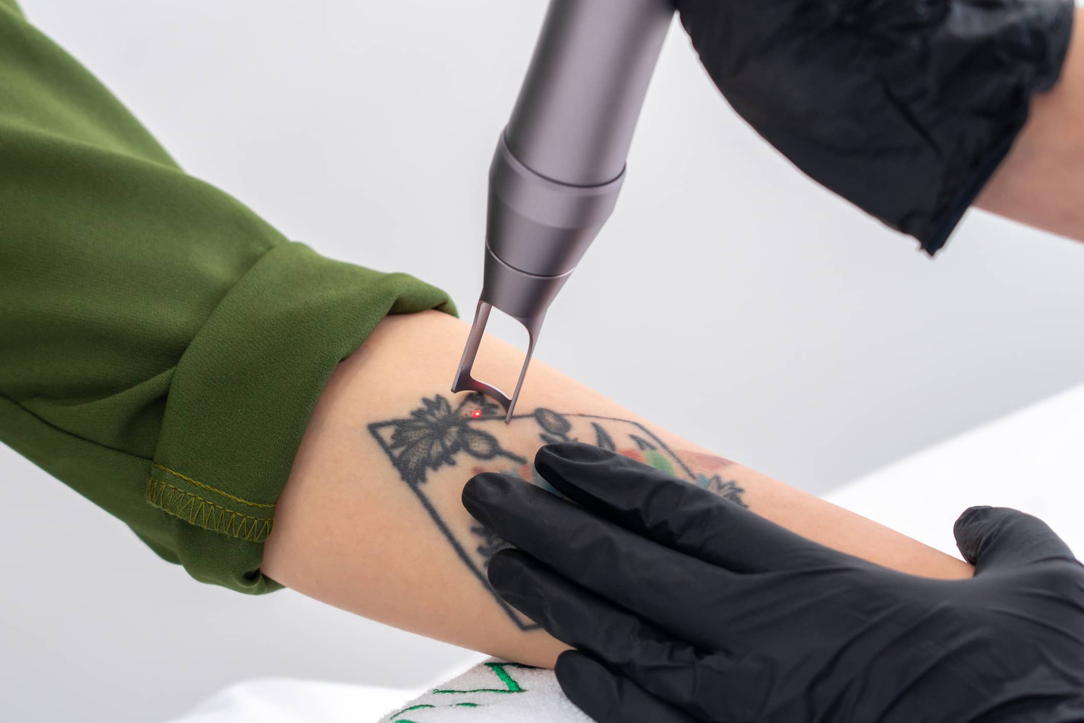 Cosmetologist Removing A Tattoo With Laser Device Female Hand.